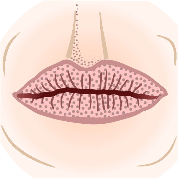 Dry Mouth